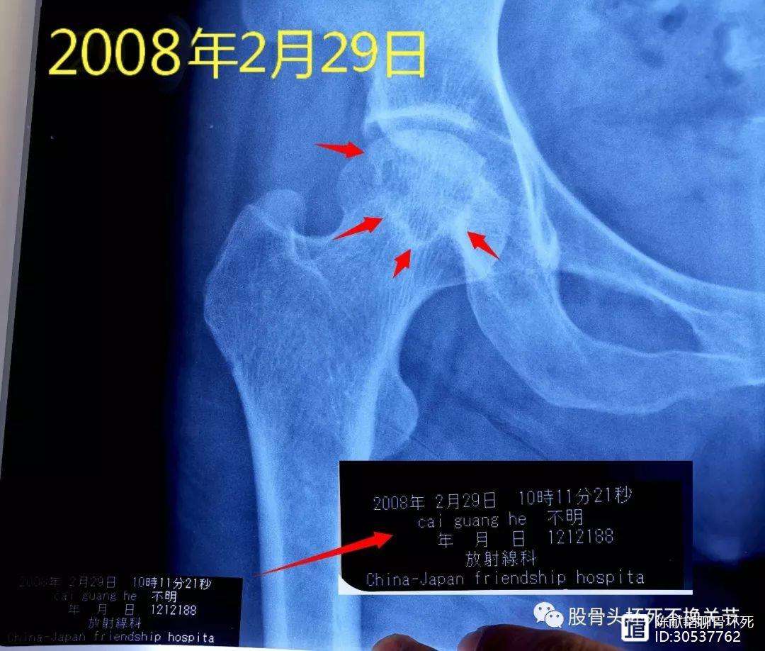 江门人工骨头医保报销多少(人工骨头医保报销多少比例)